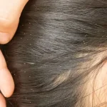 Causes of Head Lice