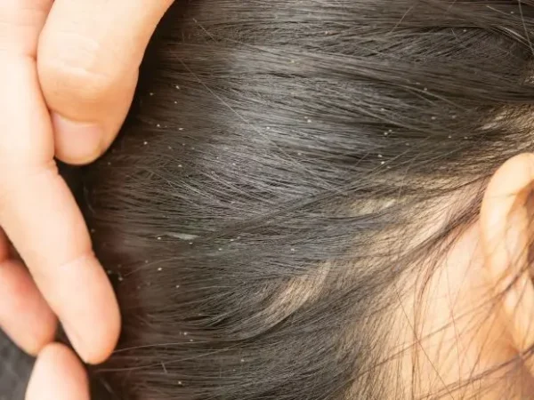 10 Causes of Head Lice You Should Know and How to Prevent Them