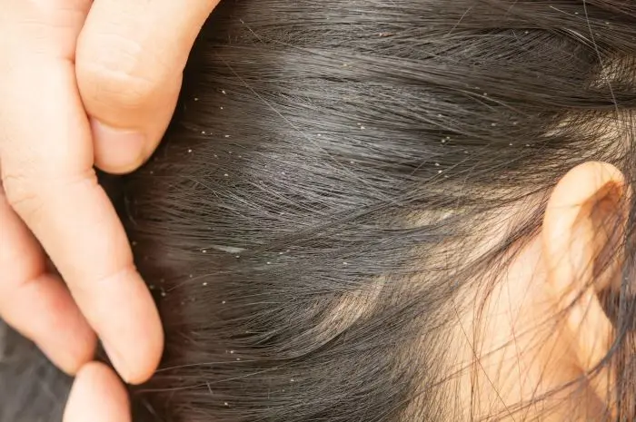 10 Causes of Head Lice You Should Know and How to Prevent Them